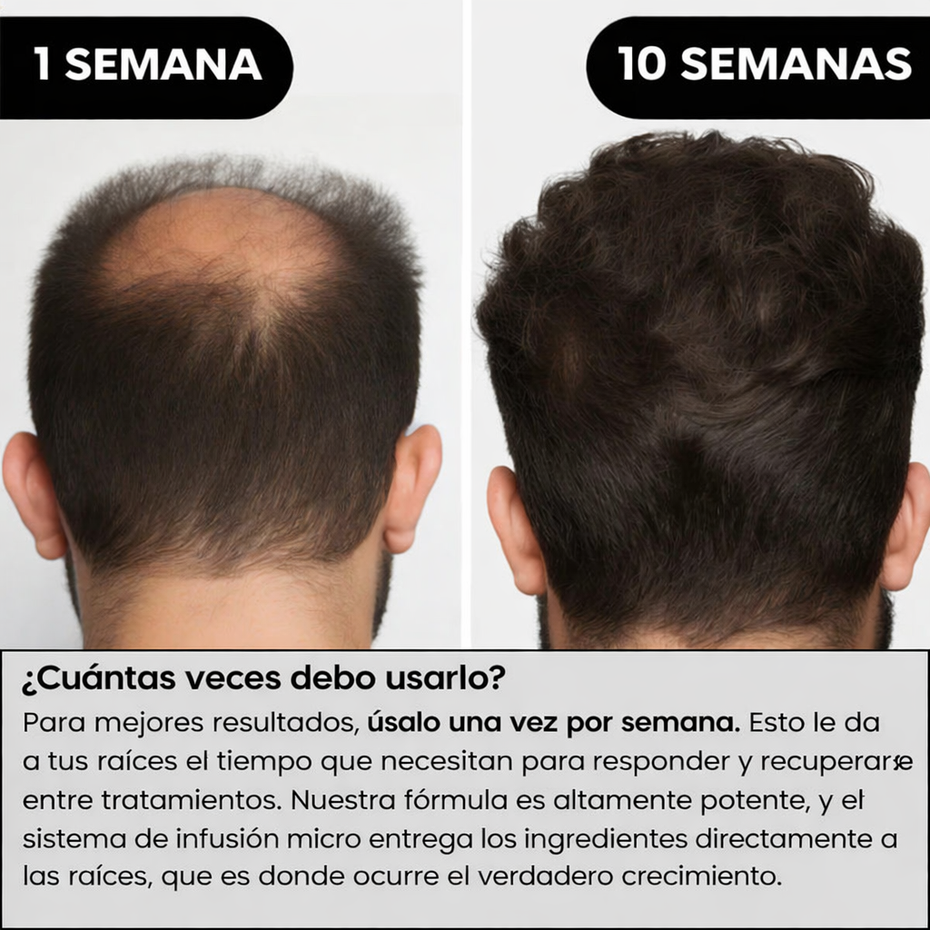 Sistema de Regeneración Capilar AlphaInfuse™