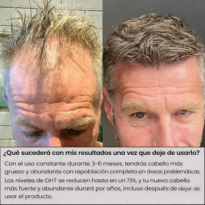 Sistema de Regeneración Capilar AlphaInfuse™